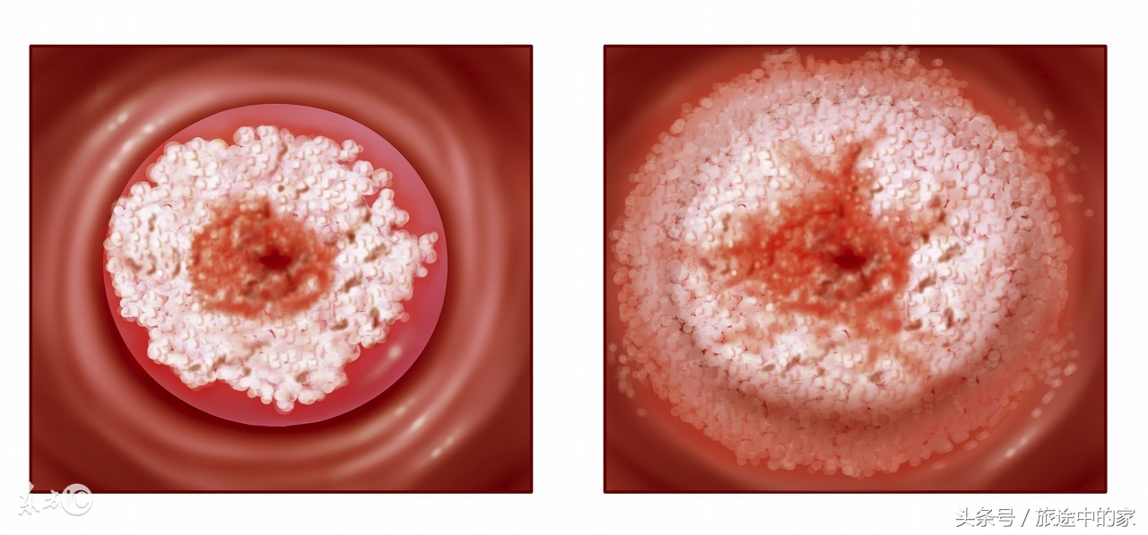 10种常见癌症早期症状知道能救命,这6种高发疾病要当心