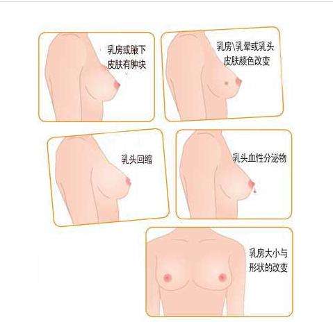 乳腺增生2级怎么调理最好方法,乳腺增生和腋下淋巴结怎么调理