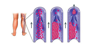 弱激光体外血液净化预防血栓，改善肺栓塞等严重情况