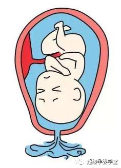 破水漏尿,怀孕38周破水宫口开到6指还要破水