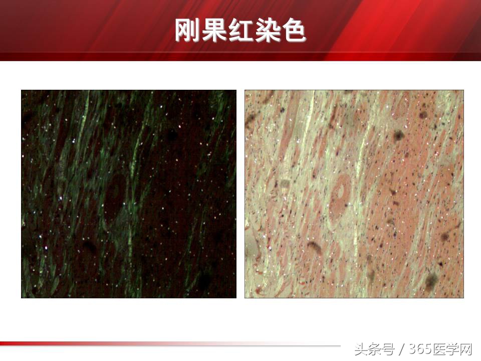 心力衰竭心房颤动,心衰时心肌酶的变化