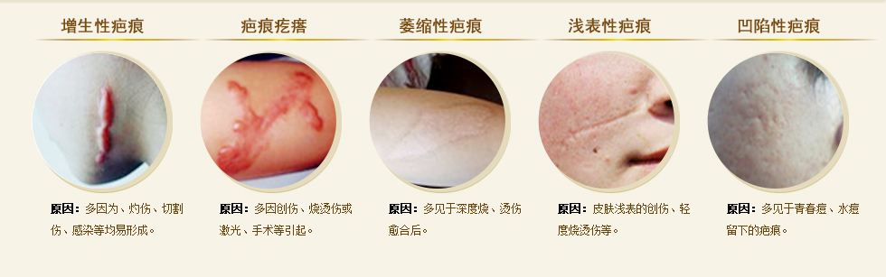 激光祛黑色素疤痕真的有效吗,激光祛烫伤黑色素疤痕