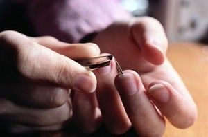 孩子手上扎了刺不弄出来有事吗,手上扎刺去医院处理需要多少钱