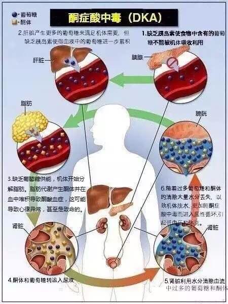 糖尿病酮症酸中毒的症状怎么治疗,糖尿病酮症酸中毒什么症状和表现