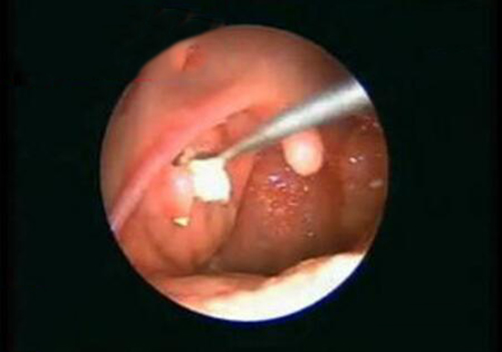 总感觉喉咙里面有东西抠不出来,嗓子有异物感还咳出石头