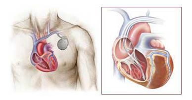 心脏起搏器引起呼吸困难处理,心脏起搏器怎么停止
