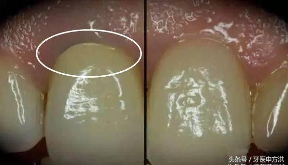 烤瓷牙边缘变黑了怎么修复,烤瓷牙真牙变黑了怎么处理