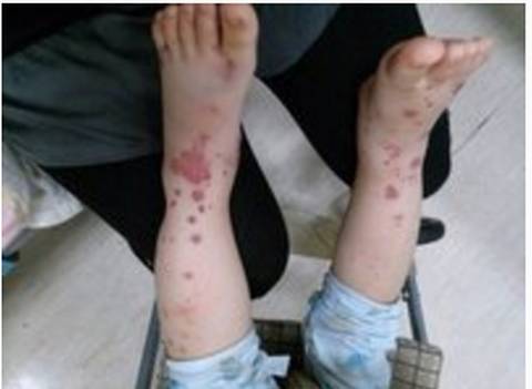 过敏性紫癜出院了并非万事大吉，胡桂生主任提醒还要小心翼翼！