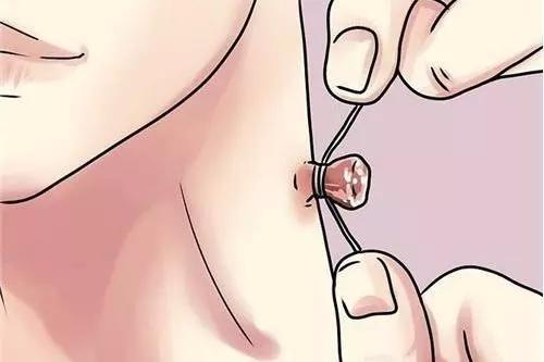 脖子上小揪揪可以剪掉吗,脖子上的小揪揪自己会掉吗