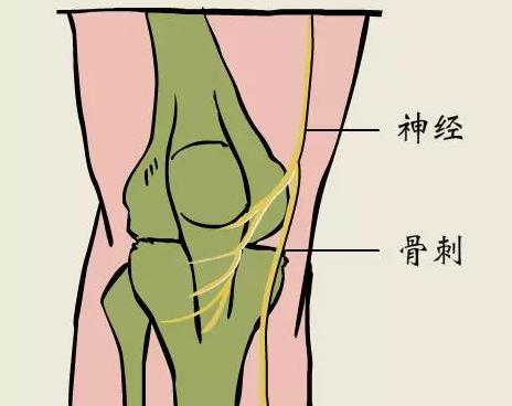 中医治疗骨刺特效方,治老年骨刺有效的膏药
