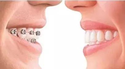 隐形牙套和钢牙套各有什么优缺点,儿童整牙是隐形牙套好还是钢牙好