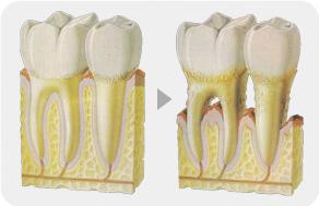 牙龈萎缩会怎么样,牙龈萎缩有什么办法修复牙