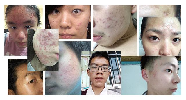 跟我这样做，不出3个月，痘痘全消散