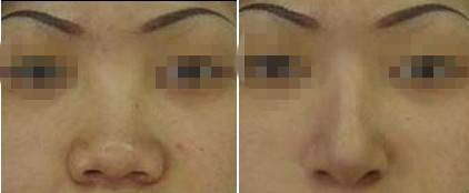 鼻子整形的方法有几种,鼻子整形能改变容貌吗