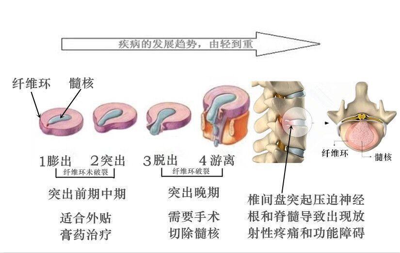 腰椎间盘突出的防治知识,健康养生知识腰椎间盘突出