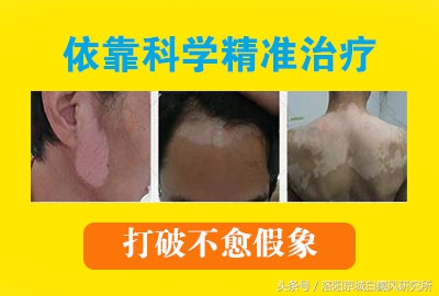 「白癜风治疗篇」白斑治不好？那是因为你不够了解它！