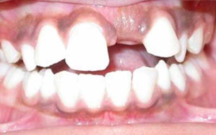 小孩换牙新牙迟迟长不出怎么办,换牙后门牙旁边两颗牙迟迟不长