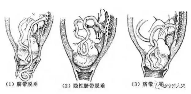 产妇突发脐带脱垂医生跪姿托举,脐带脱垂生死营救视频