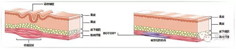 瘦脸针只打一针管用吗,瘦脸针只瘦咬肌吗