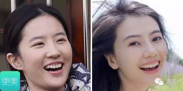 瘦脸针只打一针管用吗,瘦脸针只瘦咬肌吗