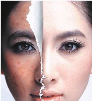 bbl光子嫩肤能祛痘印吗,如何判断光子嫩肤需要继续做了