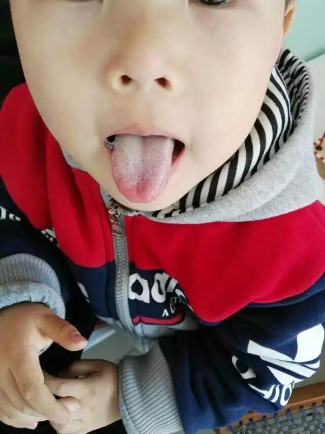 推拿小儿舌苔厚,小儿推拿舌苔知识