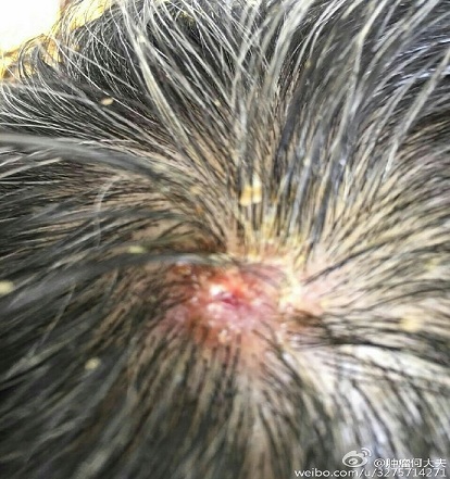 脑袋长疖子的最佳治疗方法,头皮上长了一个火疖子