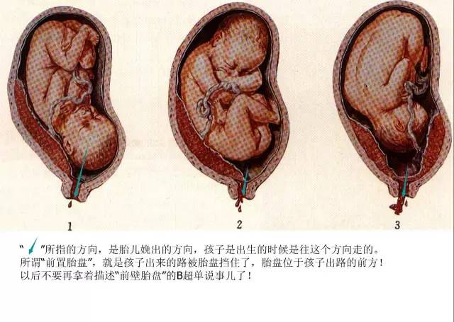 “胎盘低置态势”是个什么态势？