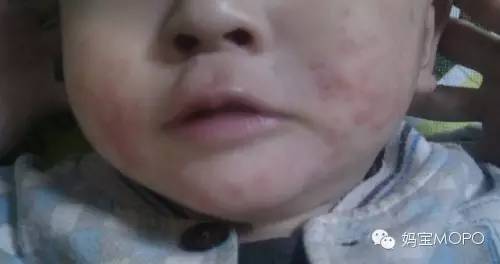 湿疹“大难题”，这些应对技巧请收好