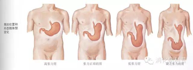 饭后运动会导致胃疼吗,饭后立即运动会导致胃下垂吗