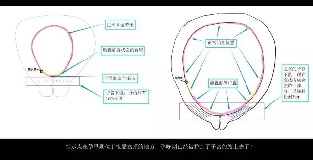 “胎盘低置态势”是个什么态势？