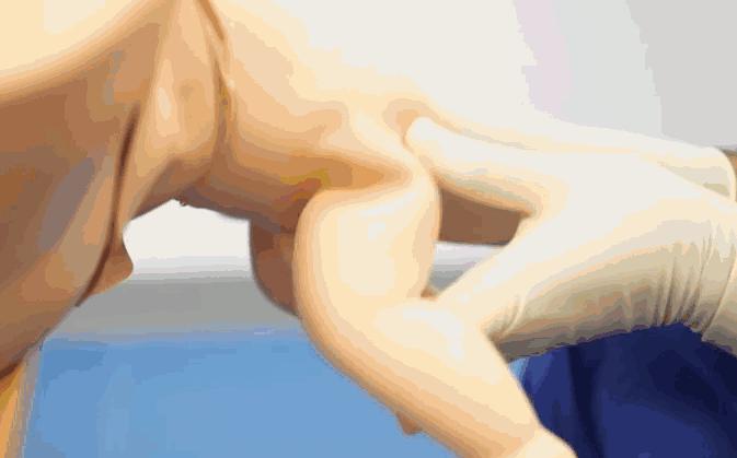 胎儿臀位出生视频,孕晚期胎儿臀位纠正视频