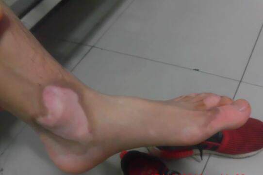 肢端型白癜风的病情是怎样的,肢端型白癜风怎么治疗