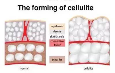 瑜伽大腿内侧训练方法,大腿内侧的肥胖纹瘦下去会消失吗