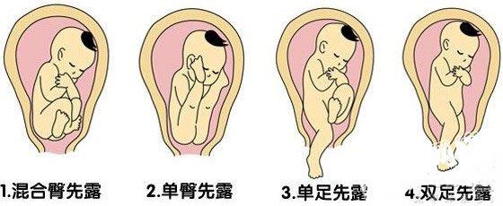 胎儿娩出后脐带长时间未剪的后果,脐带先露分娩方式