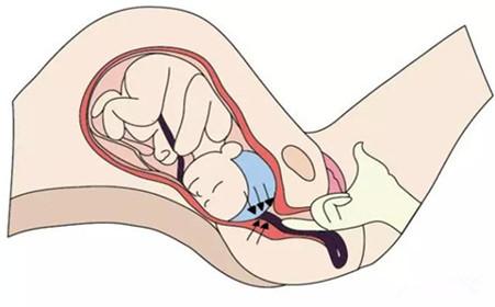 胎儿娩出后脐带长时间未剪的后果,脐带先露分娩方式