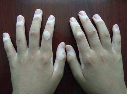 肢端型白癜风的病情是怎样的,肢端型白癜风怎么治疗