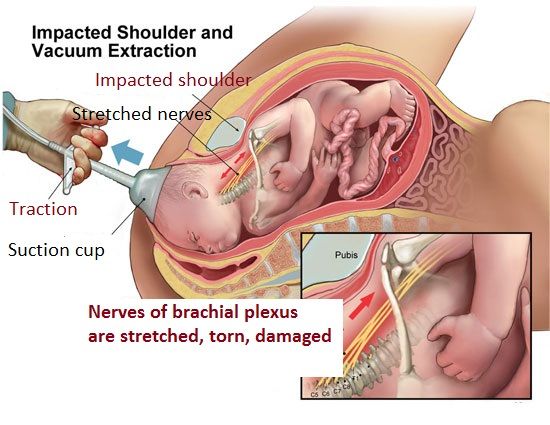 预防儿童肥胖应从胎儿期开始,控制儿童肥胖