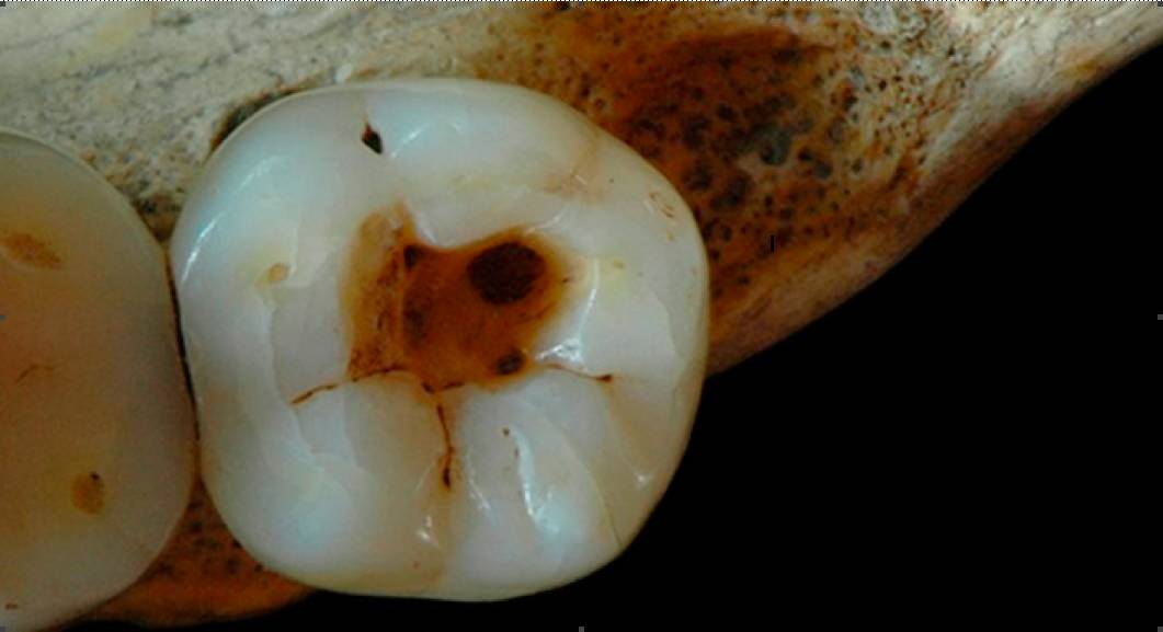 牙医如何快速知道你哪颗牙齿痛,牙齿痛小常识