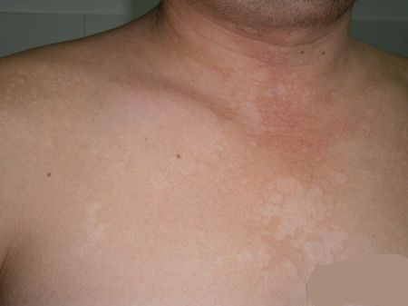 针对真菌感染的皮肤病怎么治,真菌感染皮肤问题的克星