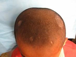 针对真菌感染的皮肤病怎么治,真菌感染皮肤问题的克星