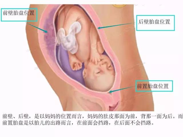 “胎盘低置态势”是个什么态势？