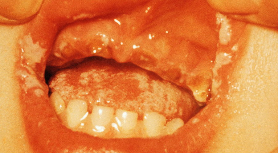 针对真菌感染的皮肤病怎么治,真菌感染皮肤问题的克星