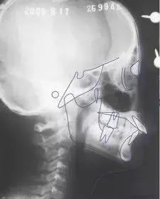 正畸过程全记录,正畸的几个阶段和步骤