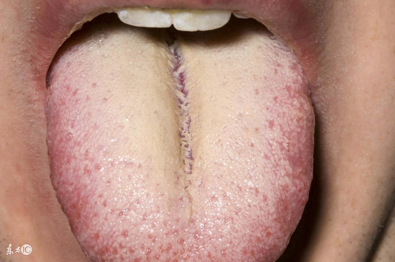 舌苔是厚厚的白苔用“姜”治口臭；舌苔发黄喝“萝卜汁”治口臭