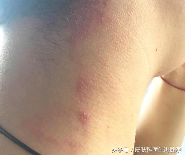 脖子带状疱疹大面积水泡,脖子起疙瘩是带状疱疹吗