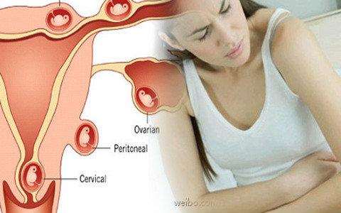 宫外孕是怎么回事儿,宫外孕是怎么回事会有哪些症状