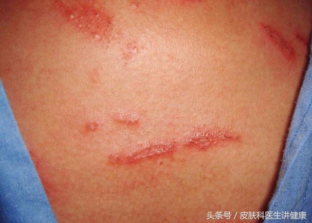 脖子带状疱疹大面积水泡,脖子起疙瘩是带状疱疹吗