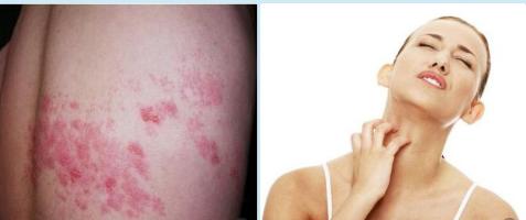 孕期肚皮痒宝妈建议,孕期肚子痒用什么止痒膏