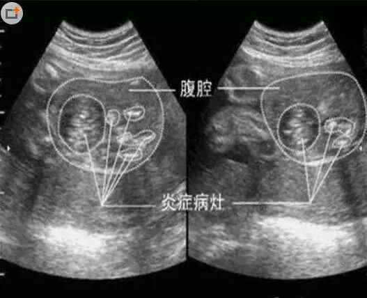 预产期开始异味什么原因,预产期到了有恶心胃难受